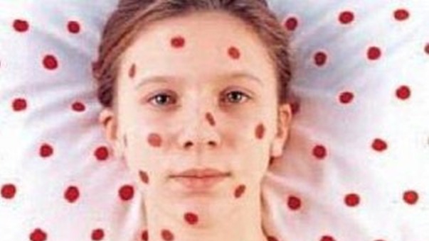 Proglašena epidemija morbila- nema epidemije gripa