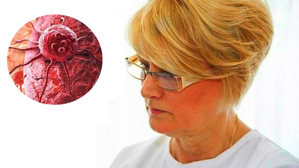 Sve više oboljelih od karcinoma